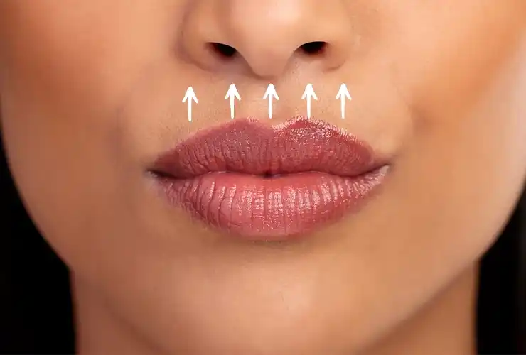 Lippenlifting