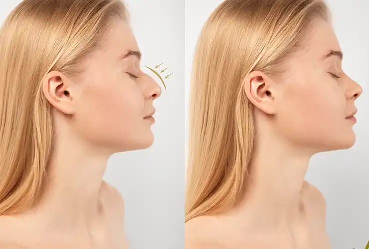 Rhinoplasty